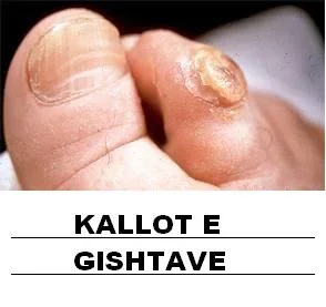 Tirane, - PRODUKTE PER PROBLEMET LEKURES SE KEMBEVE DHE DUARVE