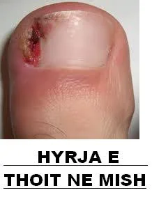 Tirane, - PRODUKTE PER PROBLEMET LEKURES SE KEMBEVE DHE DUARVE