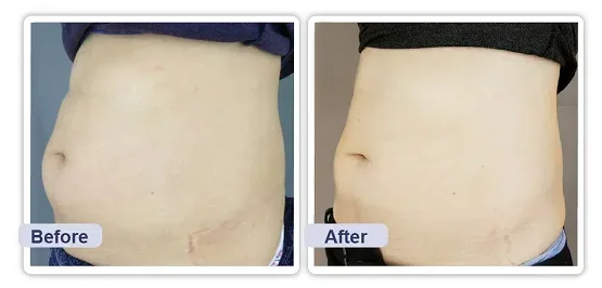 Tirane, shes pajisje laser Lipolaser - Tonifikim dhe dobësim i lokalizuar me frekuencë valësh 808 nm dhe 940 nm infra të kuqe