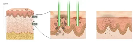 Tirane, shes pajisje laser LASER Q SWITCHED 532nm. 755nm. 1064nm. 1320nm 1 €